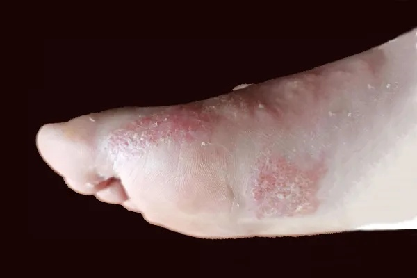 脚上怎样分辨是湿疹还是脚气（脚上怎么分辨是湿疹还是疱疹）