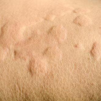 荨麻疹怎么治疗能除根（寒冷性荨麻疹怎么治疗能除根）
